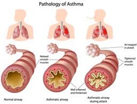 Asthma Doctor NYC 1