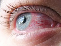 Allergic Eye Condition