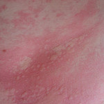 Allergic Skin Reactions